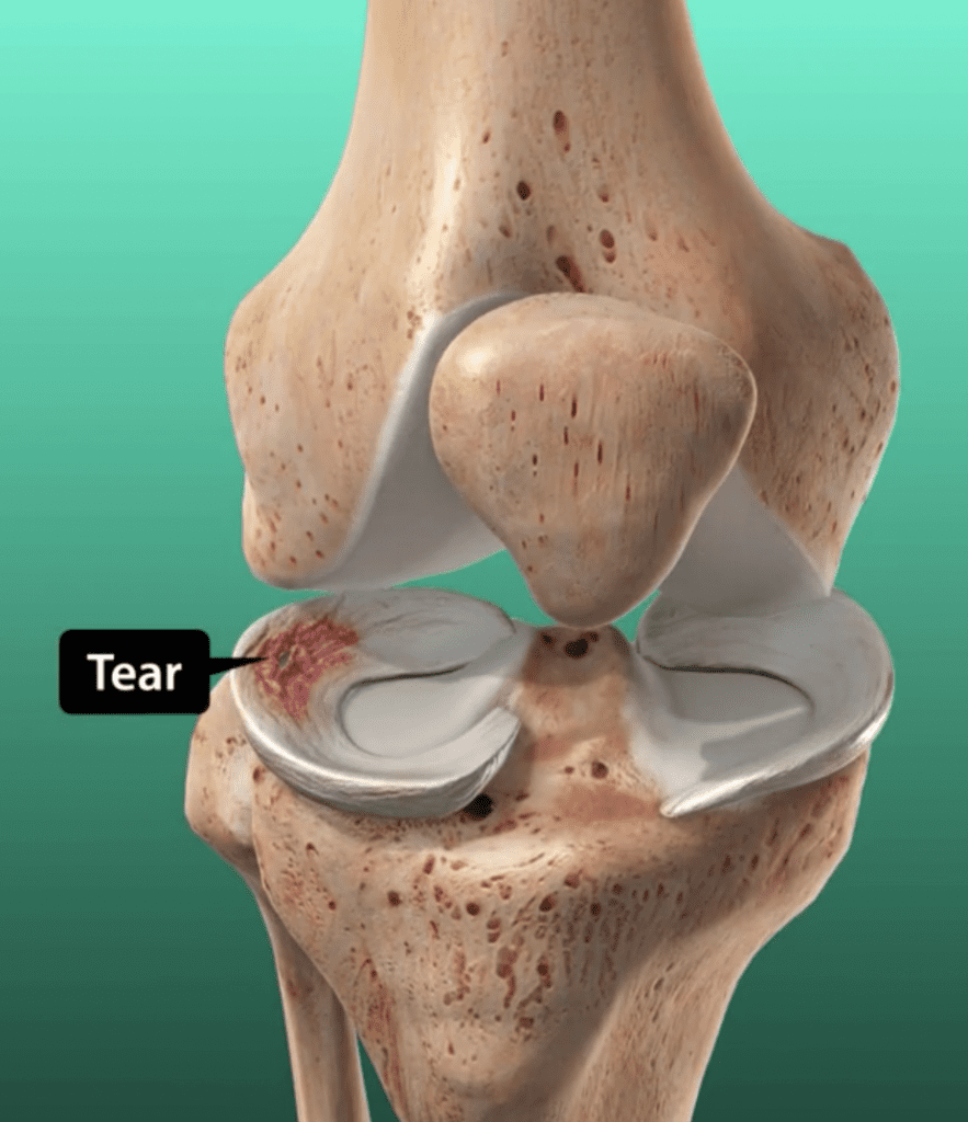 Meniscus Tear Specialist